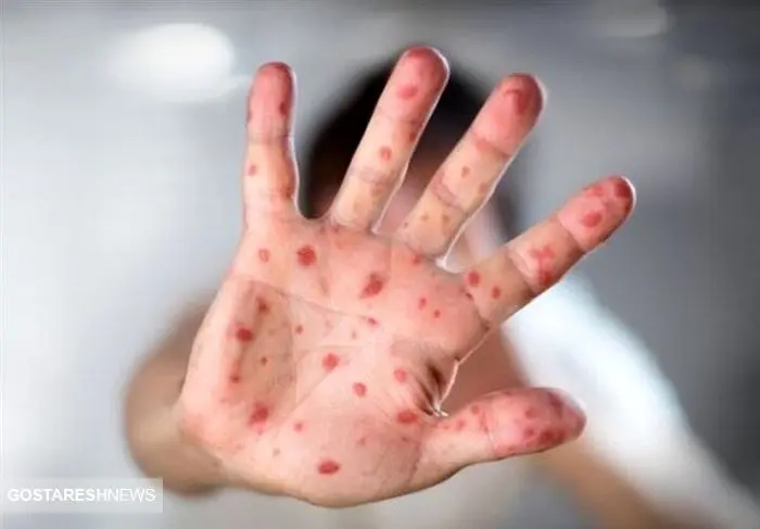 هشدار بیماری | اتباع افغان و پاکستان سوغاتی تازه آوردند !